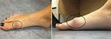 Great Toe Arthritis Treatment Photos