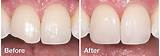 Dental Bonding Before And After Pics Images