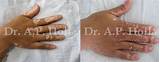 Segmental Vitiligo Treatment Images