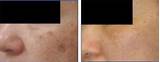 Photos of Laser Removal Spots
