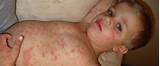 Measles Pneumonia Treatment