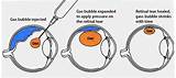 Retinal Detachment Surgery Gas Bubble Pictures