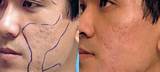 Images of Laser Treatment For Pimples