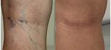 Pictures of How Much Is Vein Treatment