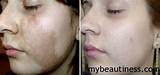 Black Spot On Face Removal Pictures