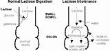 What Causes Gas And Diarrhea After Eating Images