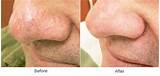 Spider Veins On Nose Laser Treatment Photos