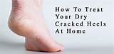 Photos of Why Cracked Heels