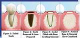 Tooth Extraction Recovery Timeline Images