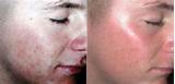 Laser Treatment For Pimples Photos