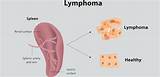 Pictures of Lymphoma Symptoms Treatment