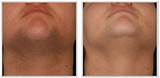 Laser Treatment For Facial Hair Removal Side Effects