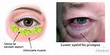 Pictures of Upper Eyelid Infection Home Remedies