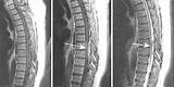 Photos of Spinal Cord Abscess Treatment