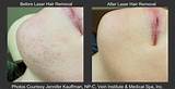 Photos of Pimples After Laser Hair Removal Treatment