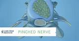 Chiropractic Treatment For Pinched Nerve In Neck Images