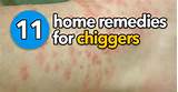 Pictures of Red Bugs Chiggers Home Remedies