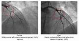 Heart Cath Recovery Time Images
