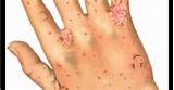 Scabies Mattress Cleaning Pictures