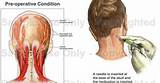 Chiari Malformation Headache Treatment Pictures