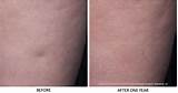 Images of Cellulite Treatment San Diego