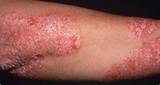Pictures of Is There A Treatment For Psoriasis