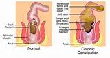 What Causes Excessive Gas And Constipation