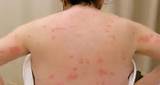 Treatment For Bed Bugs On A Person Pictures