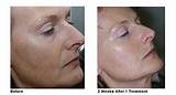 Photos of Facial Spot Removal
