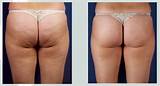 Pictures of Ultrasonic Fat Reduction And Radio Frequency Skin Tightening Treatments