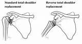 Shoulder Joint Replacement Surgery Recovery Pictures
