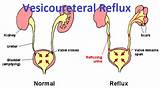 Pictures of Vesicoureteral Reflux Treatment
