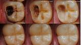Pictures of Colloidal Silver Root Canal