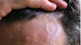 Images of Ear Psoriasis Treatment