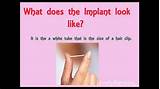 Does The Implant Hurt Birth Control Pictures