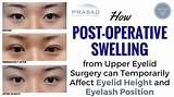 Asian Blepharoplasty Recovery