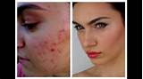 Covering Acne Scars With Makeup