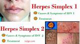 Pictures of What Kind Of Doctor For Herpes