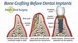 Pain After Dental Bone Graft