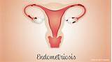 Questions To Ask Your Doctor About Endometriosis Images