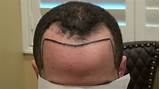 Images of Temple Balding Treatment