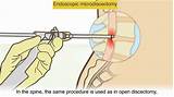 Images of Herniated Disk L5 S1 Treatment