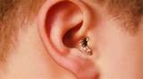 Images of Ear Psoriasis Treatment