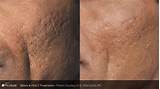 How Much Is Laser Skin Treatment For Acne Scars