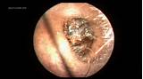 Impacted Cerumen Home Remedies Images