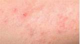 Images of Heat Rash Itchy Skin Treatment