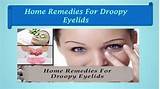 Images of Droopy Eyelids Home Remedies