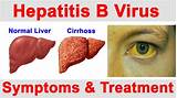 Images of Treatment For Hep B Infection