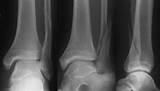 Images of Distal Fibula Fracture Recovery Time