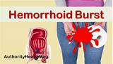 What Doctor Should I See For Hemorrhoids Photos
